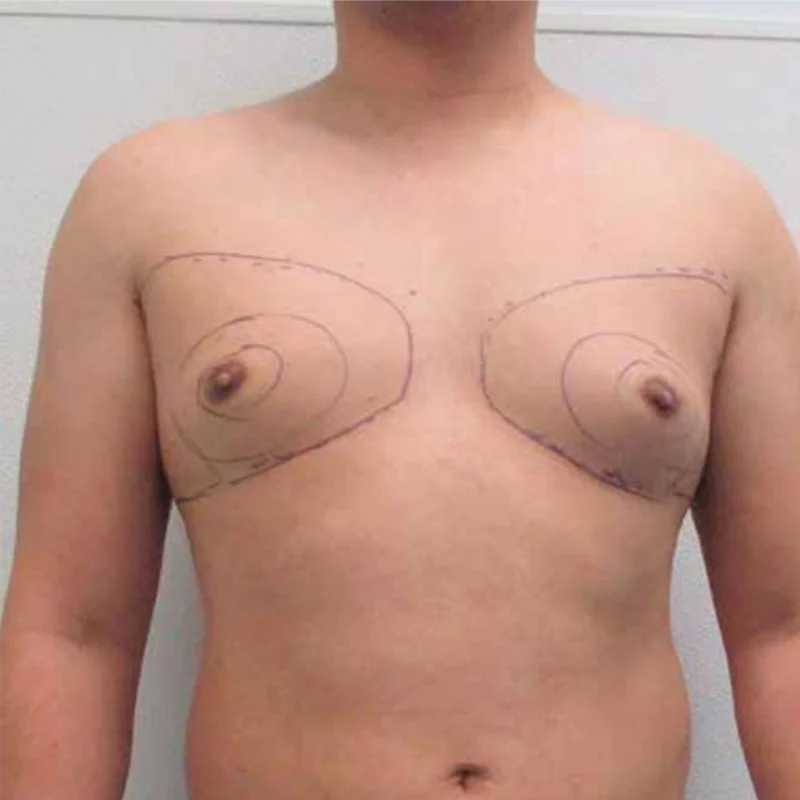 Før: En overkrop med markeringer omkring brystfedtet.